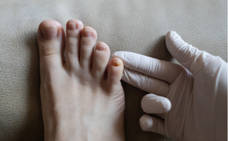 Nagelpilz