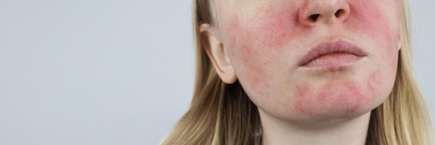 Rosacea