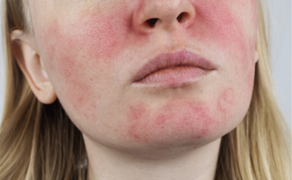 Rosacea